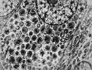 F,69y. | cystadenoma (Warthin tumor) … caruncula - (modified mitochondria in an autolysed sample) F,69y. | cystadenoma (Warthin tumor) … caruncula - (modified mitochondria in an autolysed sample)